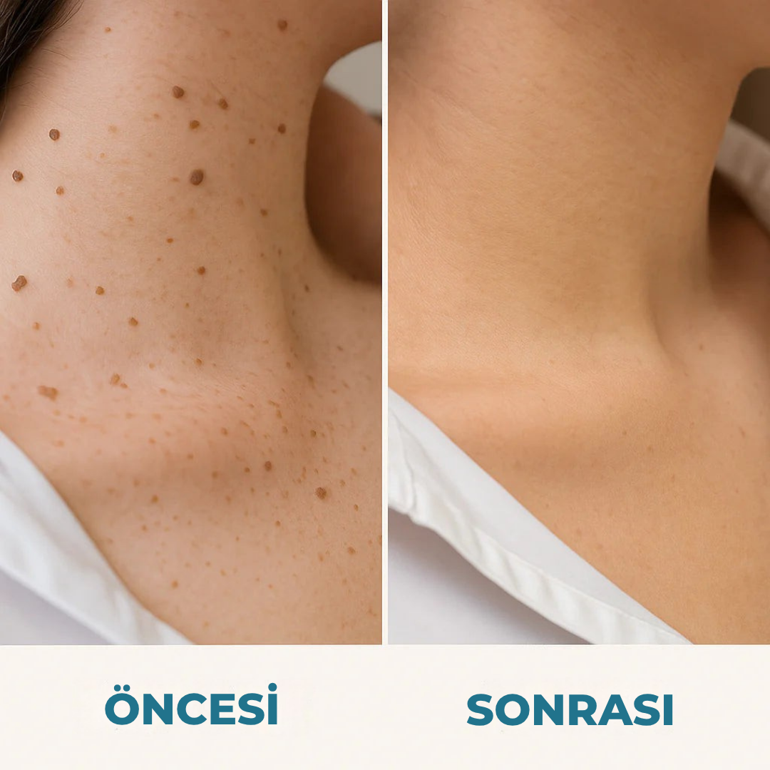 Siğilsavar™ MediSkin Lazer - Ameliyatsız Siğil ve Ben Çözümü