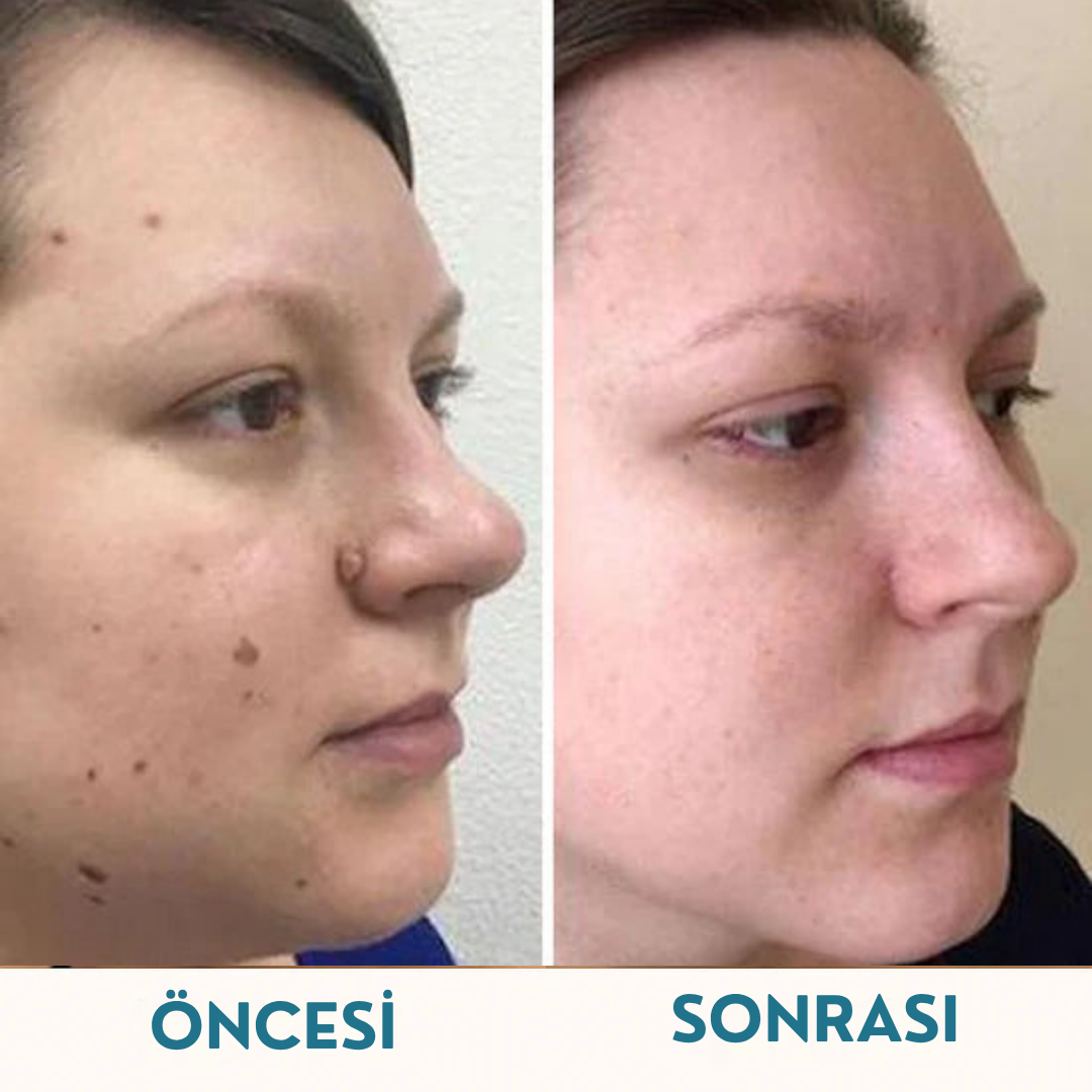 Siğilsavar™ MediSkin Lazer - Ameliyatsız Siğil ve Ben Çözümü