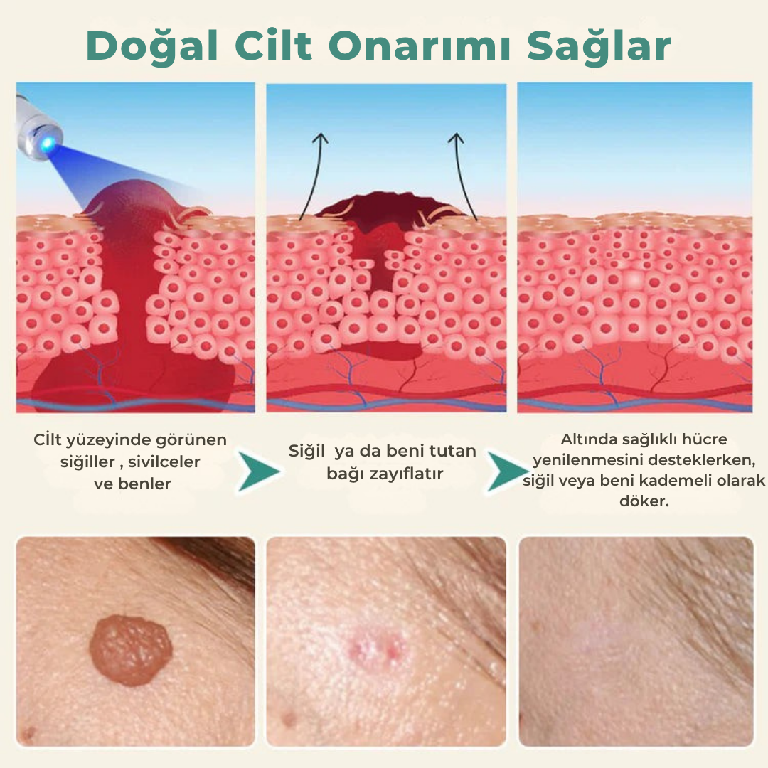 Siğilsavar™ MediSkin Lazer - Ameliyatsız Siğil ve Ben Çözümü