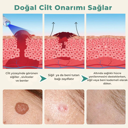 Siğilsavar™ MediSkin Lazer -  Ameliyatsız Siğil ve Ben Çözümü